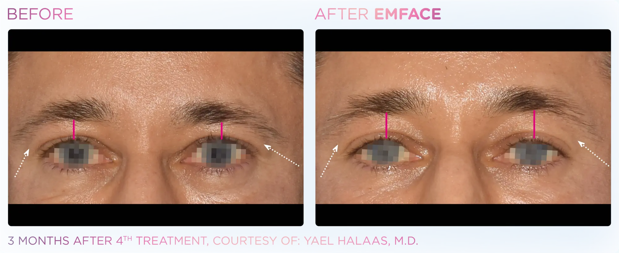EMFACE Brow - Before and After