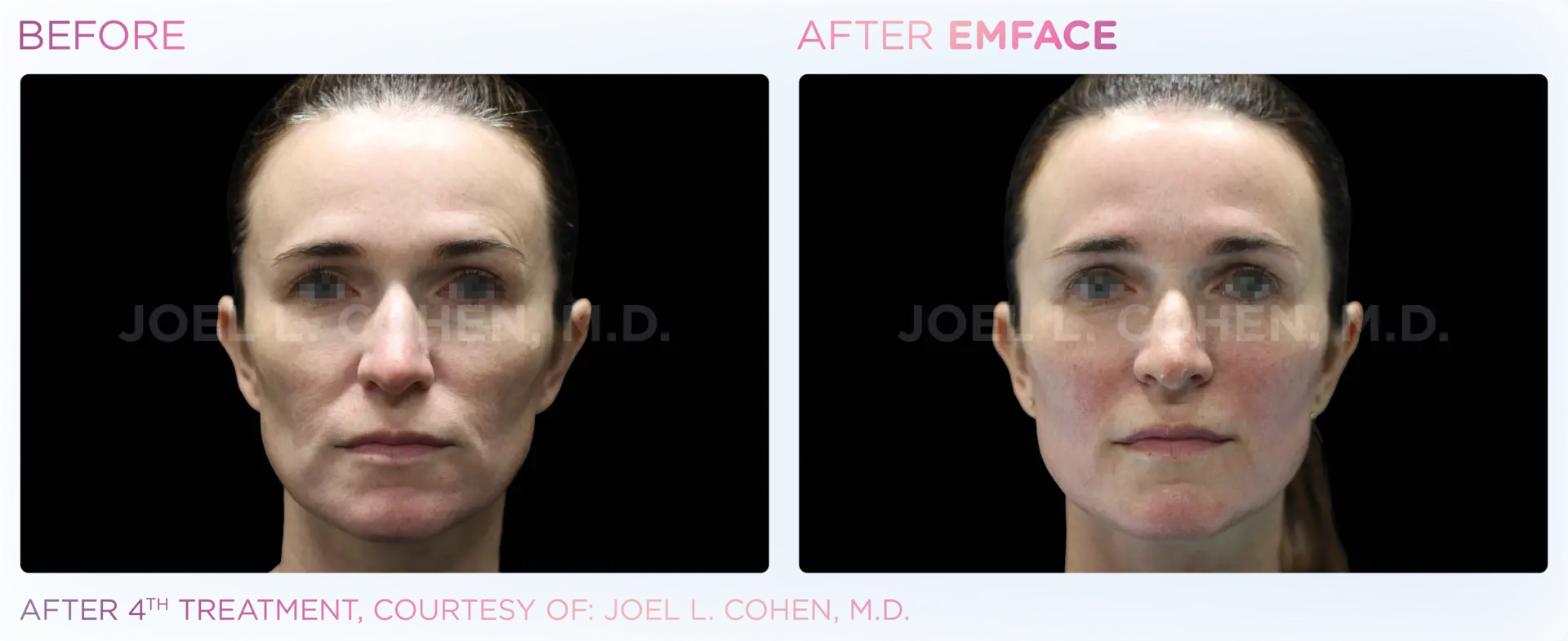 EMFACE Full Face - Before and After