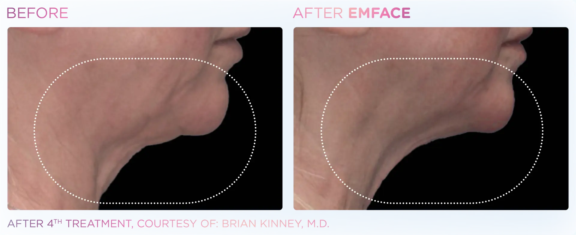 EMFACE Neck and Jaw - Before and After