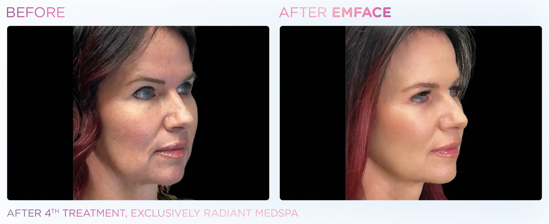 EMFACE Profile - Before and After