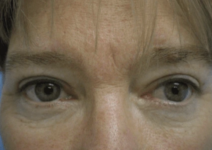 Eye-Lid-Lift-Patient after