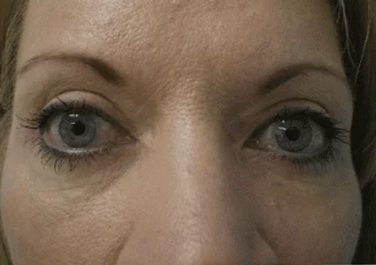 Eye Lid Lift Patient after