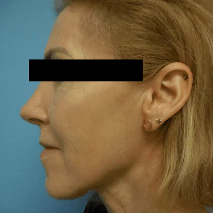 Nose Reshaping Patient After