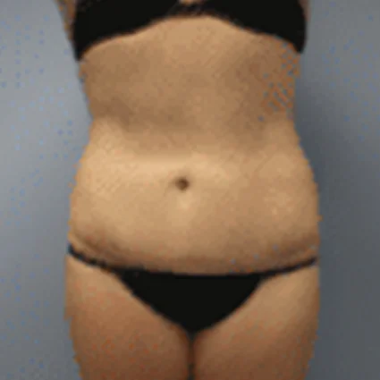 Liposuction Patient after