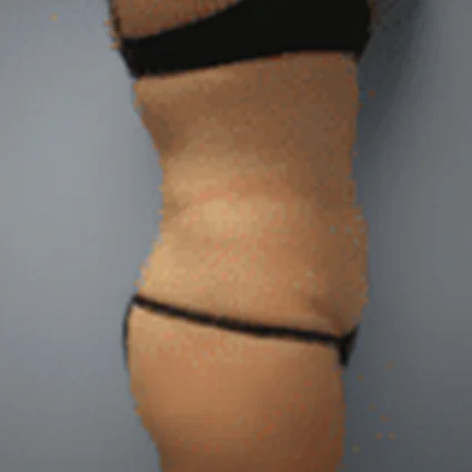 Abdominoplasty Patient after
