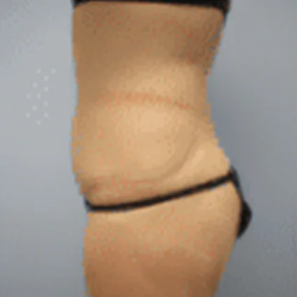 Abdominoplasty Patient after