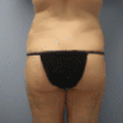 Abdominoplasty Patient after