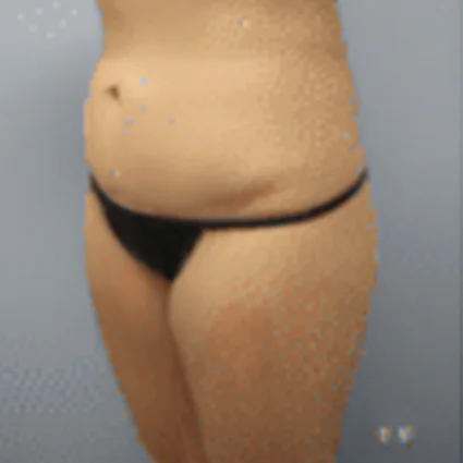 Abdominoplasty Patient after