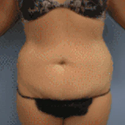 Abdominoplasty Patient before