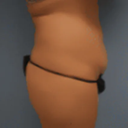 Abdominoplasty Patient before