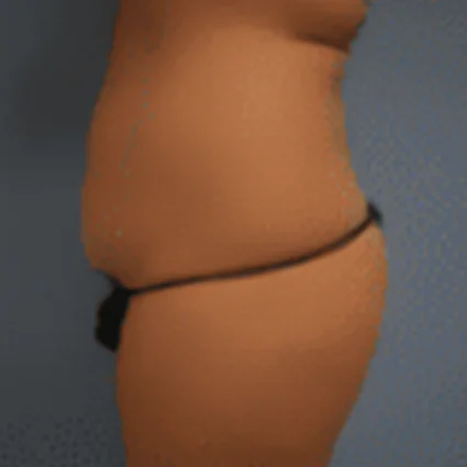 Abdominoplasty Patient before