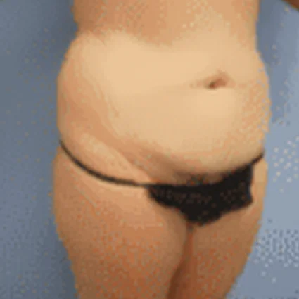 Abdominoplasty Patient before