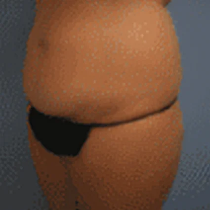 Abdominoplasty Patient before