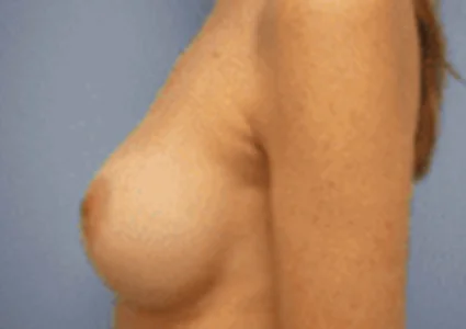 Breast Augmentation after
