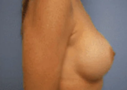 Breast Augmentation after