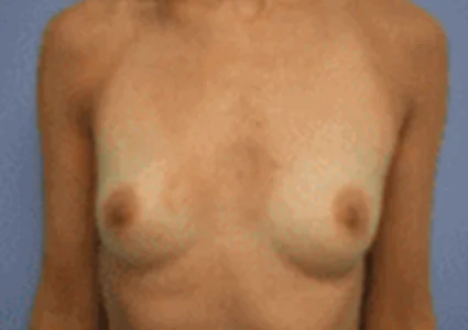 Breast Augmentation before