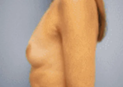 Breast Augmentation before