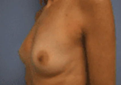 Breast Augmentation before