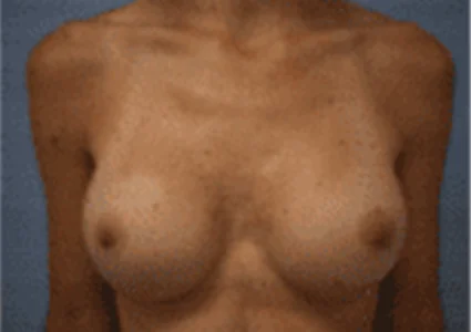 Breast Augmentation after