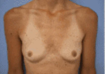 Breast Augmentation before