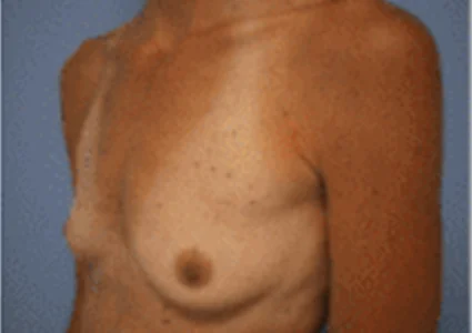 Breast Augmentation before