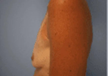 Breast Augmentation before