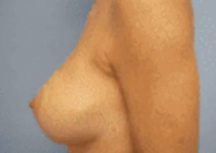 Breast Augmentation after