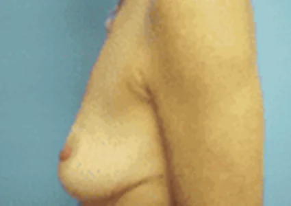 Breast Augmentation before