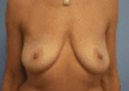 Breast Augmentation before