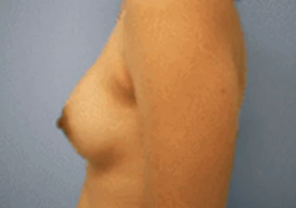 Breast Augmentation after