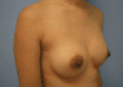 Breast Augmentation after