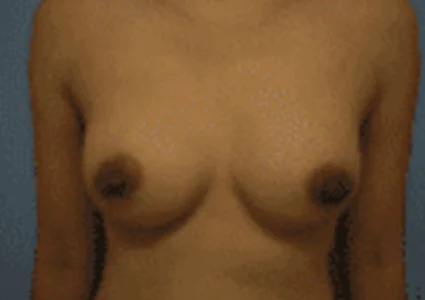 Breast Augmentation after