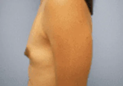 Breast Augmentation before