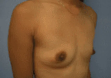 Breast Augmentation before