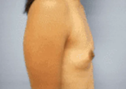 Breast Augmentation before