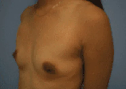 Breast Augmentation before