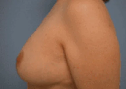 Breast Reduction Patient after