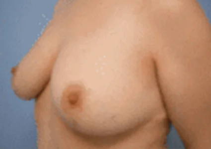 Breast Reduction Patient after