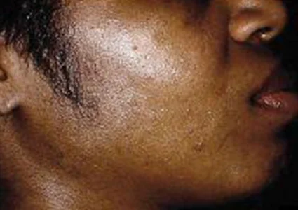 Laser & Radiofrequency after