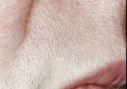 Laser & Radiofrequency after