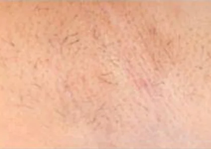 Laser & Radiofrequency after