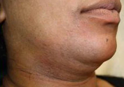 Laser & Radiofrequency after