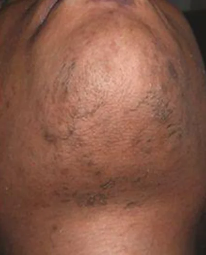 Laser & Radiofrequency after