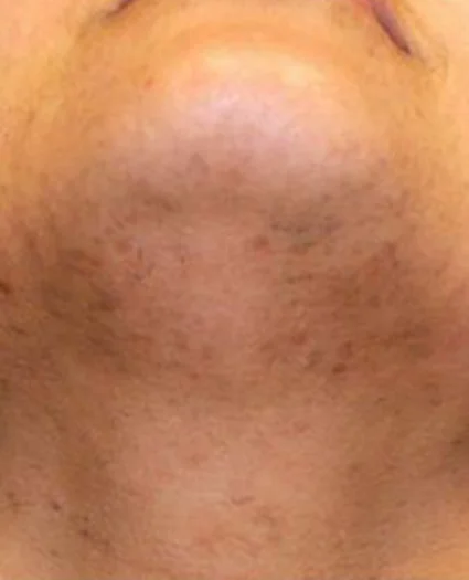 Laser & Radiofrequency after