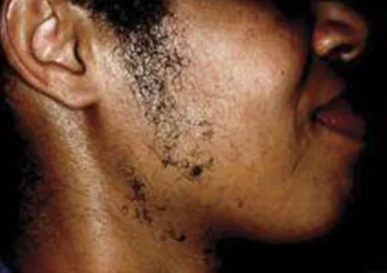 Laser & Radiofrequency before