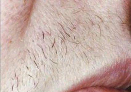 Laser & Radiofrequency before