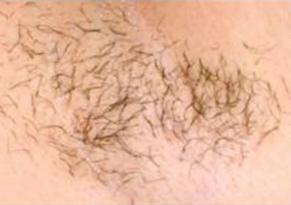 Laser & Radiofrequency before