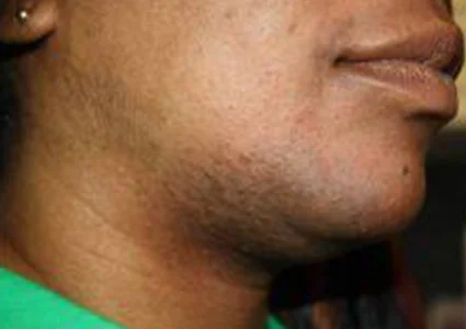 Laser & Radiofrequency before