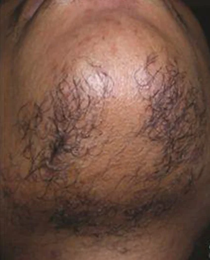 Laser & Radiofrequency before