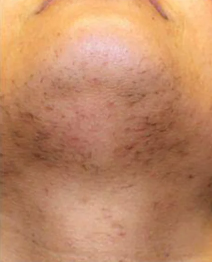 Laser & Radiofrequency before